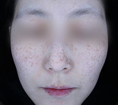 Before pigment treatment