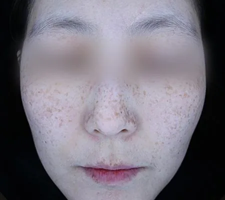 Before One Day Pigment Clear treatment in Seoul — patient 1