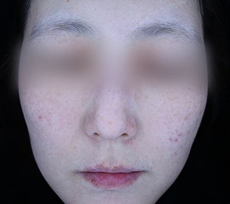 After pigment treatment