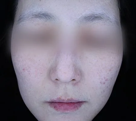 After One Day Pigment Clear treatment in Seoul — patient 1