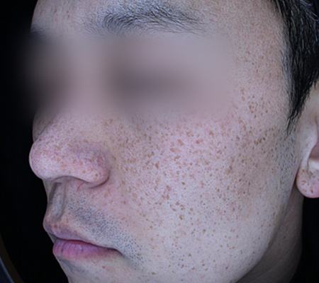 Before pigment treatment