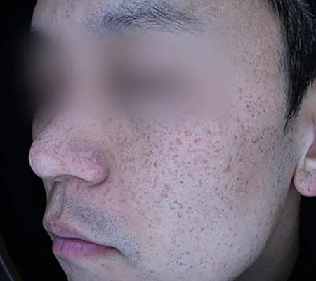 Before One Day Pigment Clear treatment in Seoul — patient 2