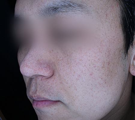 After pigment treatment