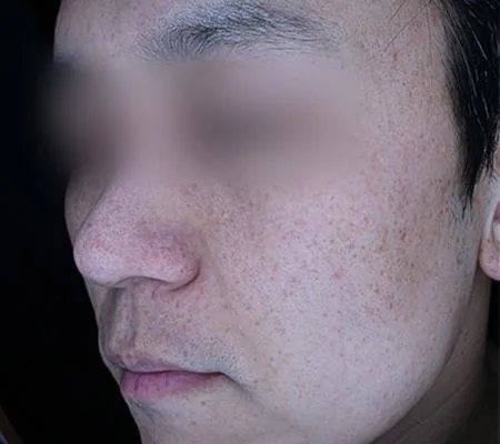 After One Day Pigment Clear treatment in Seoul — patient 2