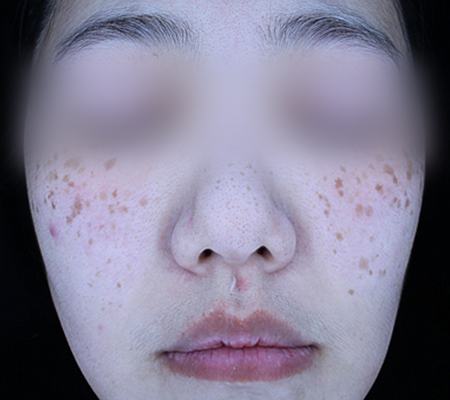 Before pigment treatment