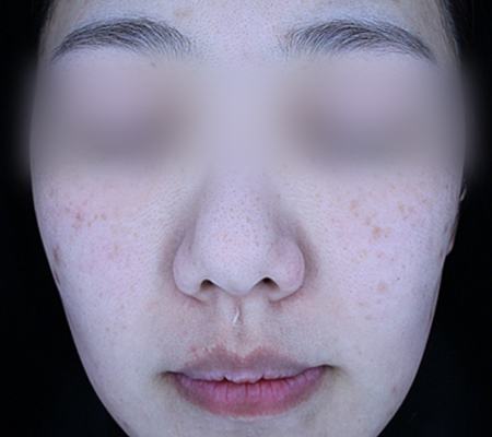 After pigment treatment