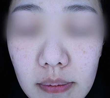 After One Day Pigment Clear treatment in Seoul — patient 3