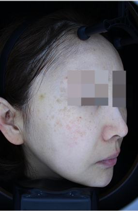 Before pigment treatment