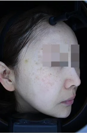 Before One Day Pigment Clear treatment in Seoul — patient 4