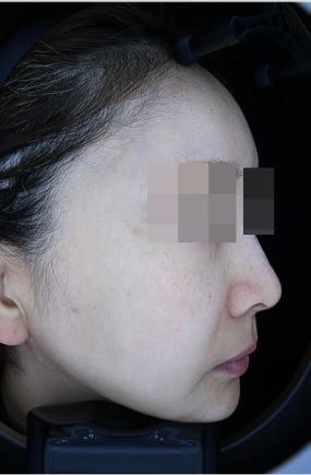 After pigment treatment