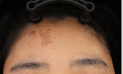 Before pigment treatment