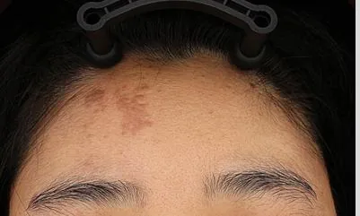 Before One Day Pigment Clear treatment in Seoul — patient 5