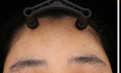 After pigment treatment
