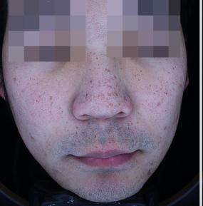 Before pigment treatment