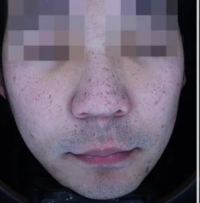 Before One Day Pigment Clear treatment in Seoul — patient 6