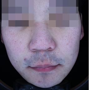 After pigment treatment