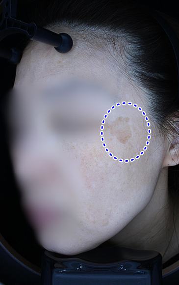 Before pigment treatment