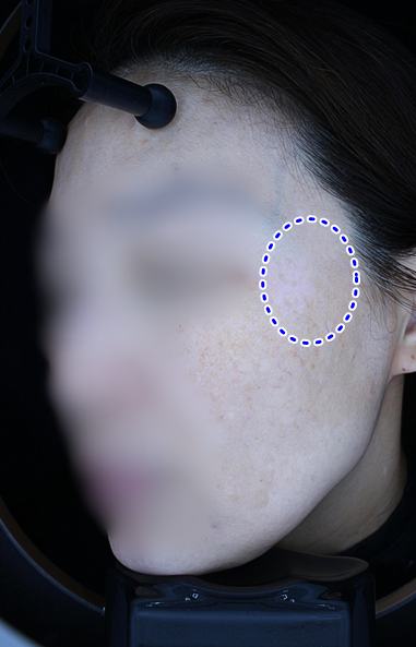After pigment treatment