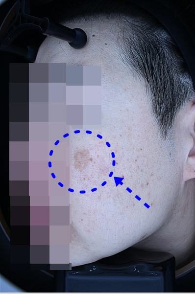 Before pigment treatment