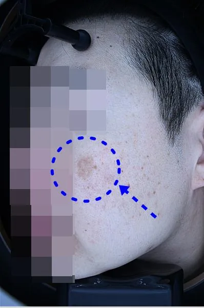Before One Day Pigment Clear treatment in Seoul — patient 8