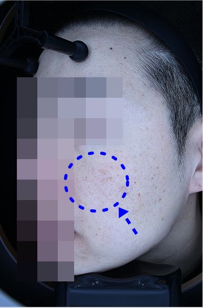 After pigment treatment