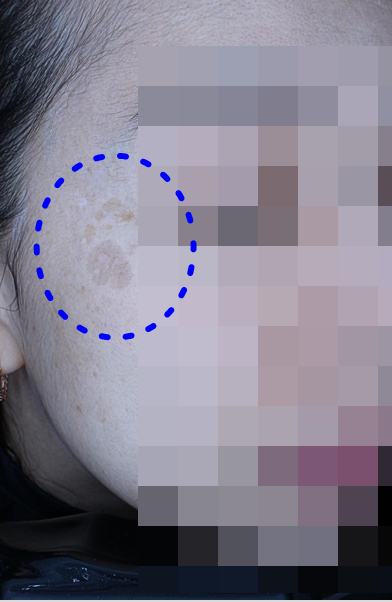 Before pigment treatment