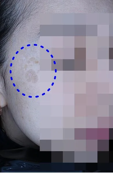 Before One Day Pigment Clear treatment in Seoul — patient 9