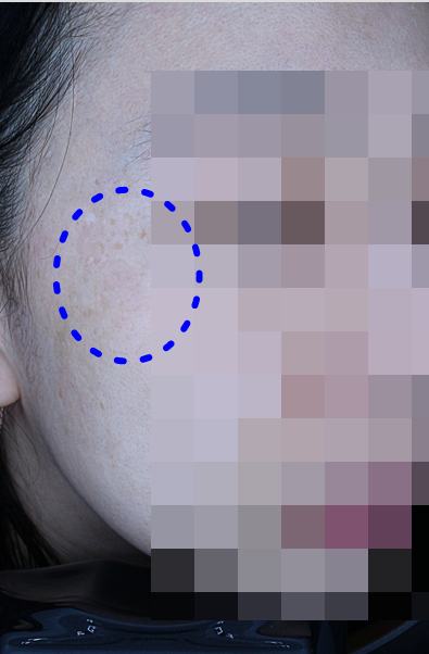 After pigment treatment