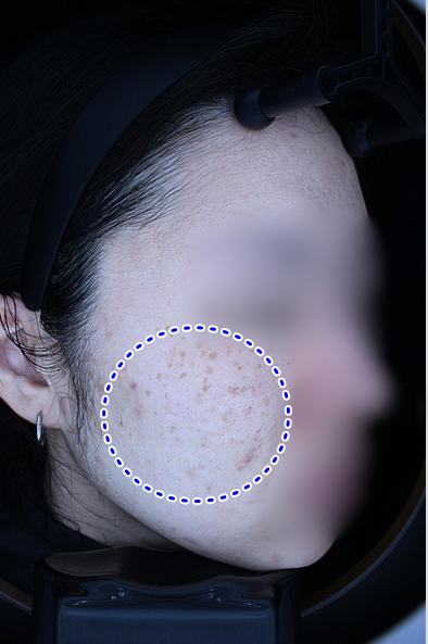Before pigment treatment