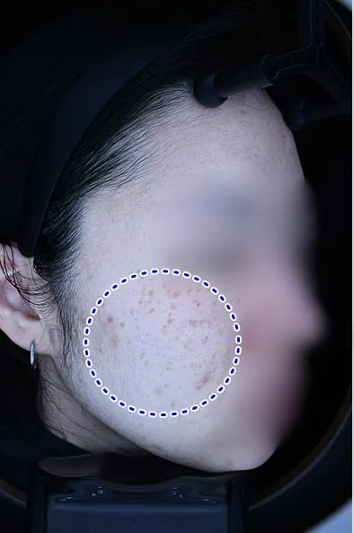 Before One Day Pigment Clear treatment in Seoul — patient 10