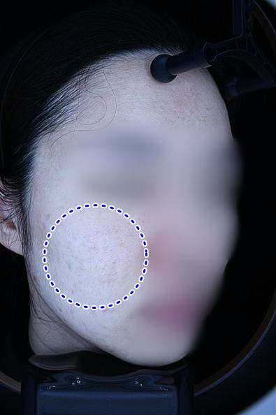 After pigment treatment
