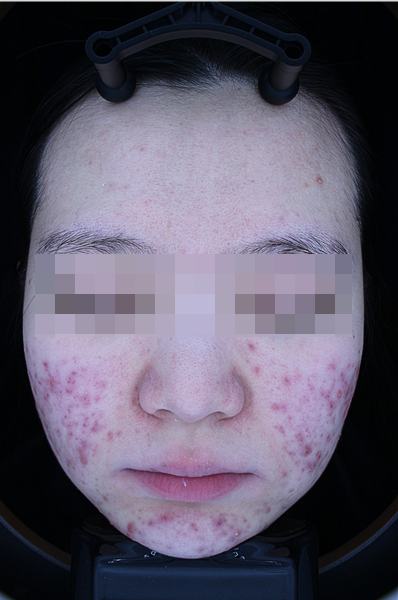 Before acne treatment