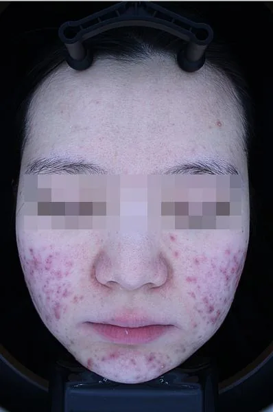 Before One Day Acne Gold PTT treatment in Seoul — patient 1
