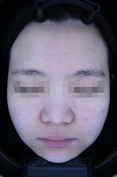 After acne treatment