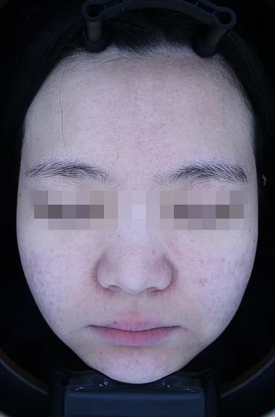 After One Day Acne Gold PTT treatment in Seoul — patient 1