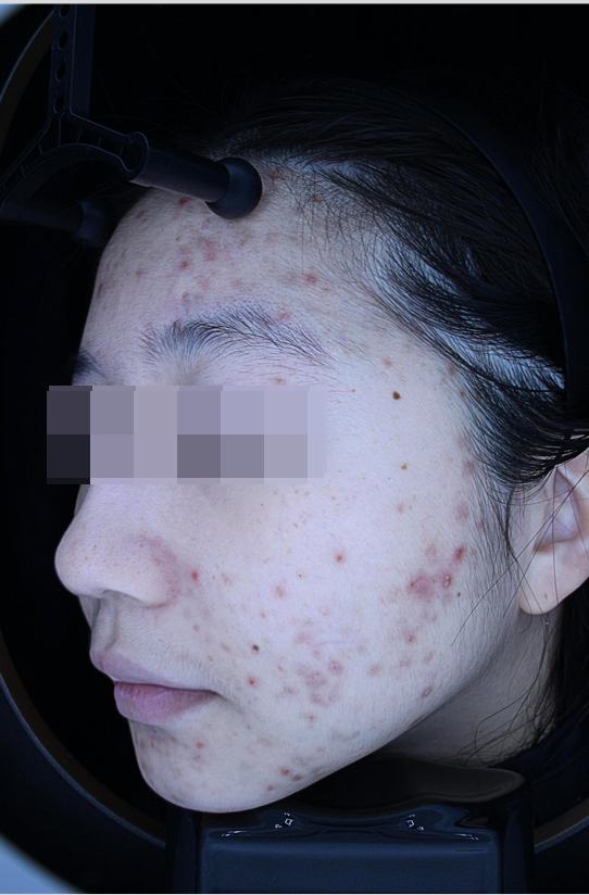 Before acne treatment