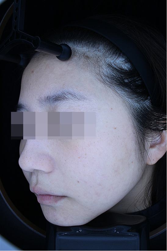 After acne treatment
