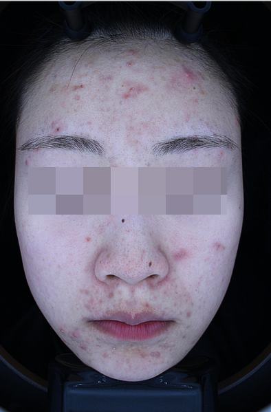 Before acne treatment