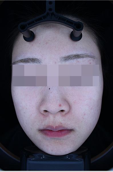 After acne treatment