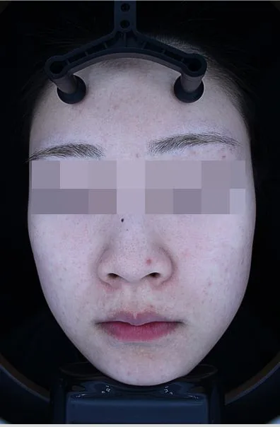 After One Day Acne Gold PTT treatment in Seoul — patient 3