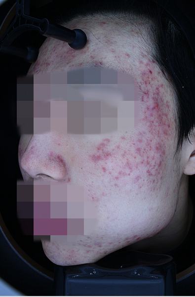 Before acne treatment
