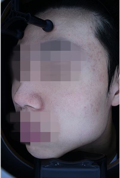 After acne treatment