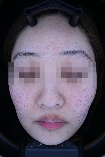 Before acne treatment