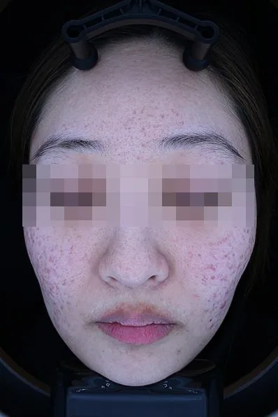 Before One Day Acne Gold PTT treatment in Seoul — patient 5