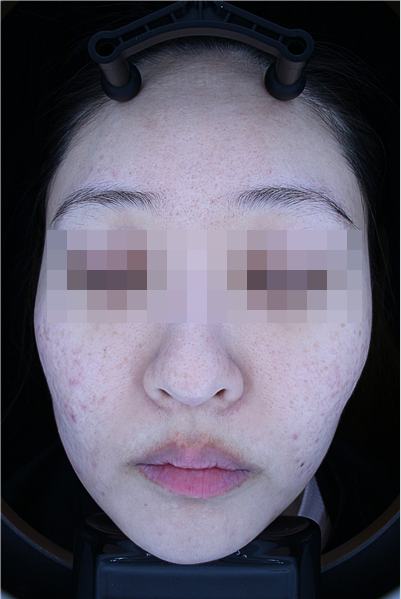 After acne treatment