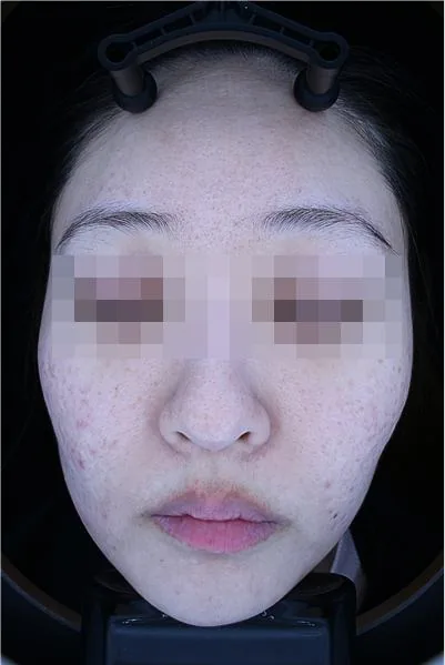 After One Day Acne Gold PTT treatment in Seoul — patient 5