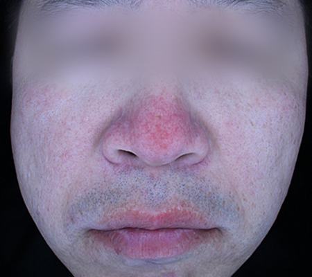 Before acne treatment