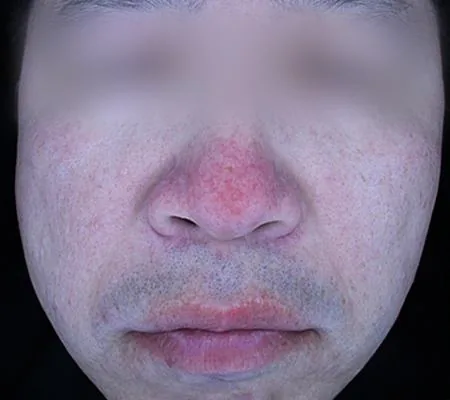 Before One Day Acne Gold PTT treatment in Seoul — patient 6