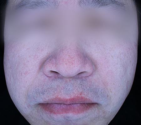 After acne treatment