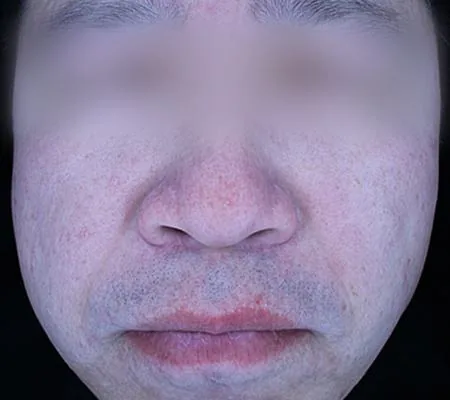After One Day Acne Gold PTT treatment in Seoul — patient 6